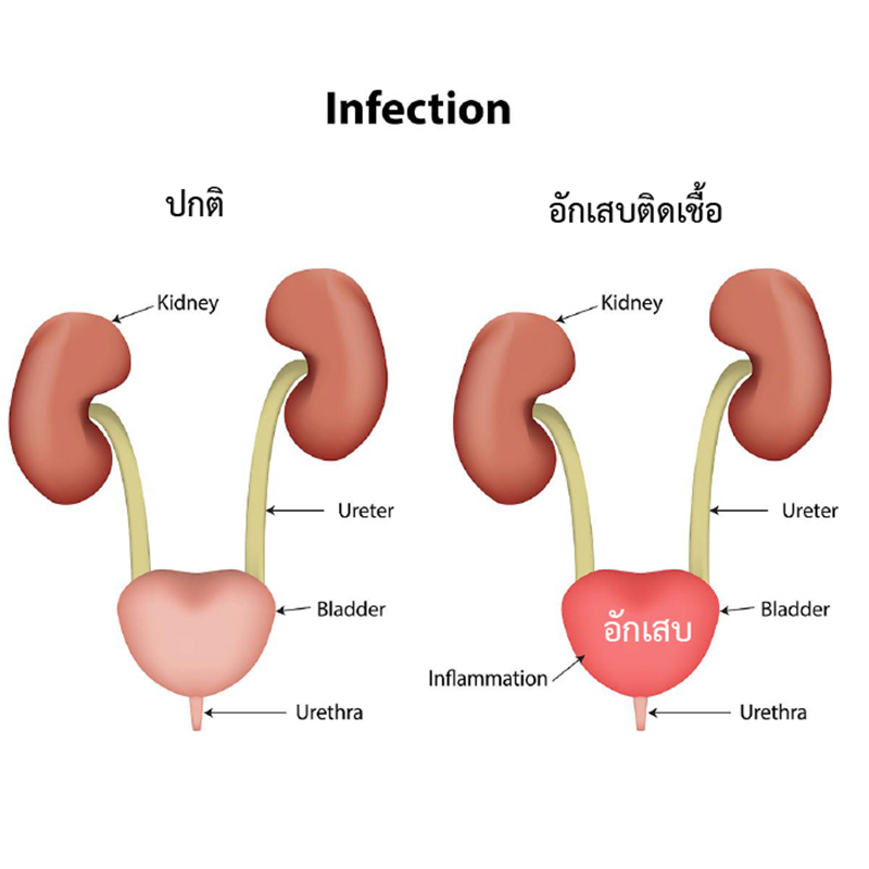 ติดเชื้อในทางเดินปัสสาวะ (Urinary Tract Infection)