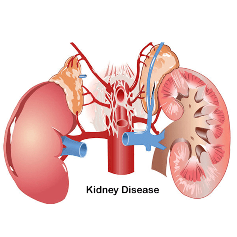 ไตวาย ไตเสื่อม (Kidney Disease)