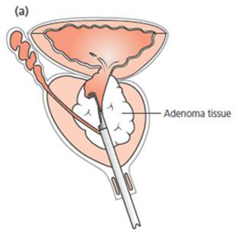 1.ผ่าตัดด้วยการส่องกล้อง (TURP)