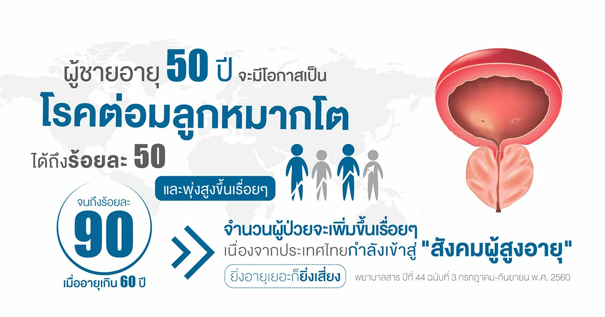 ผู้ชายอายุ 50 ปี จะมีโอกาสเป็นโรค ต่อมลูกหมากโต