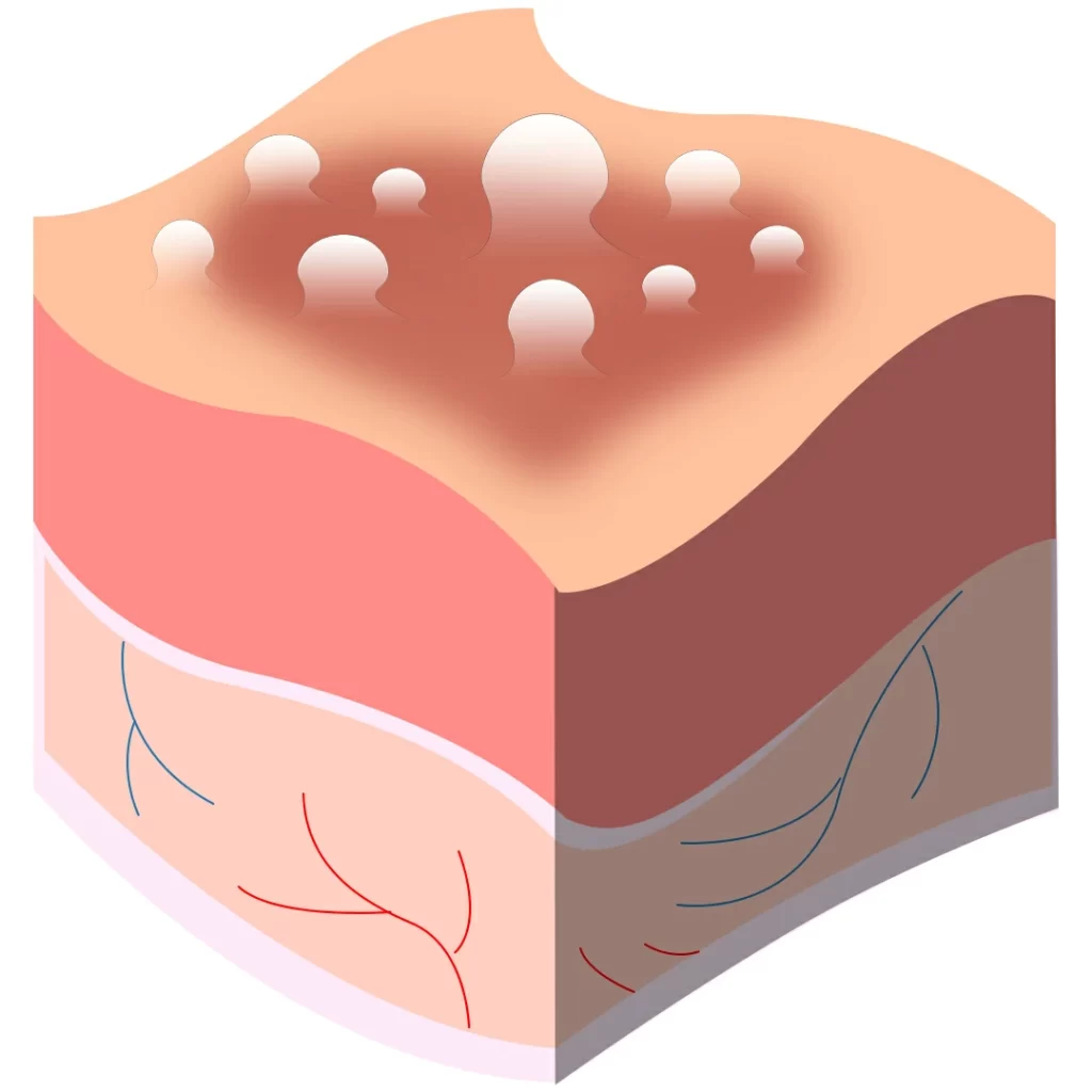 เริมที่อวัยวะเพศ (Herpes simplex infection)