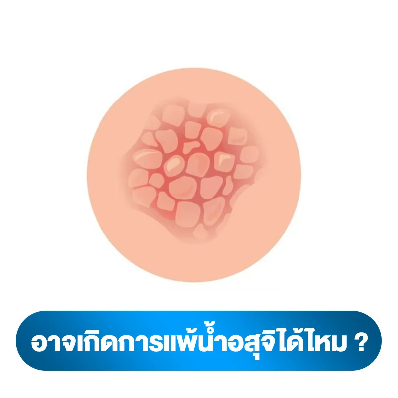 คำถามกับการกินน้ำอสุจิ เป็นอะไรไหม 6.อาจเกิดการแพ้น้ำอสุจิได้ไหม